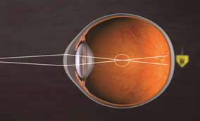 드림렌즈교정원리 이미지1