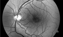 망막신경섬유층촬영